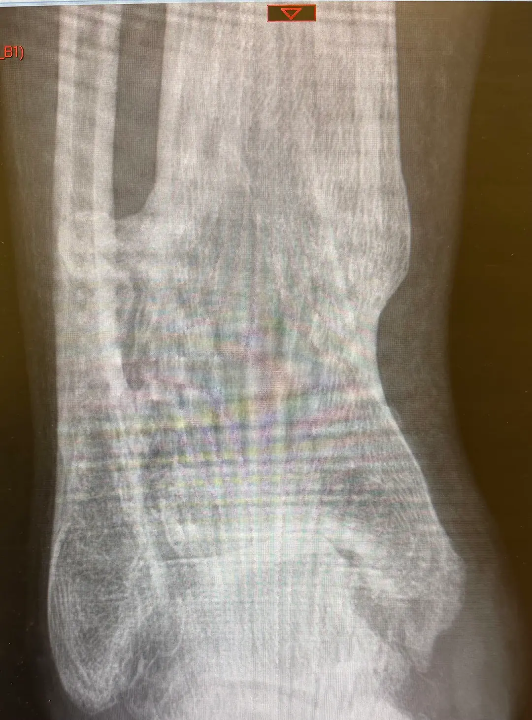 Ankle Xray