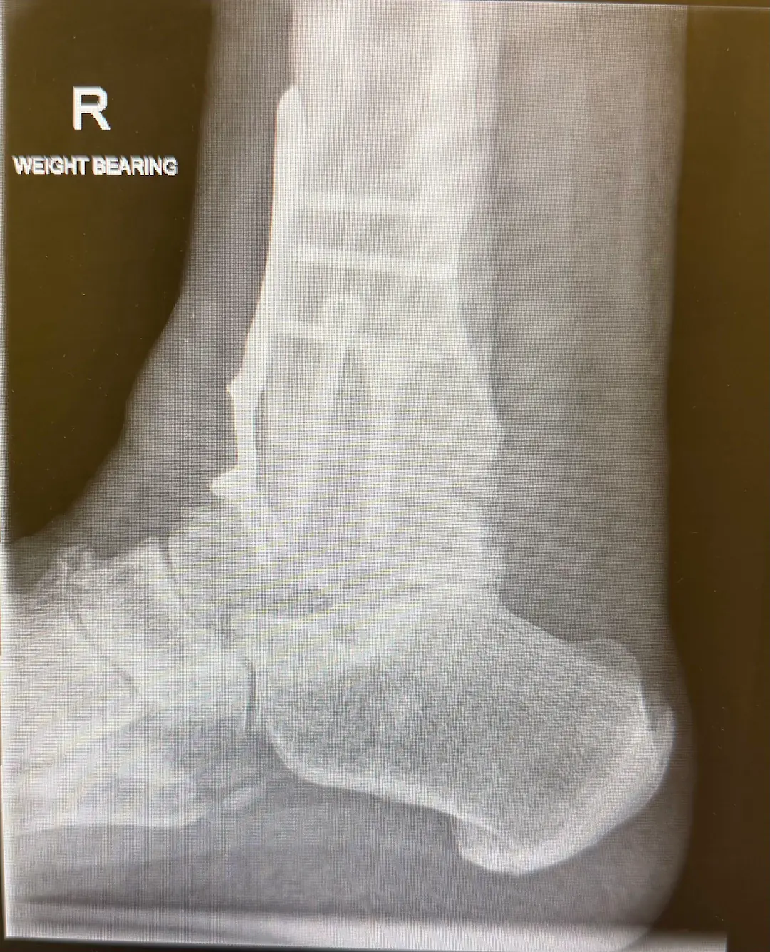 ankle fusion